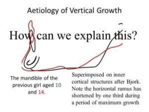 Facial-Growth-Image-2-300x225