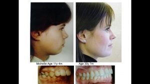Orthodontic treatment Before and After