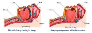 Sleep Apnoea Facial Muscle Diagram