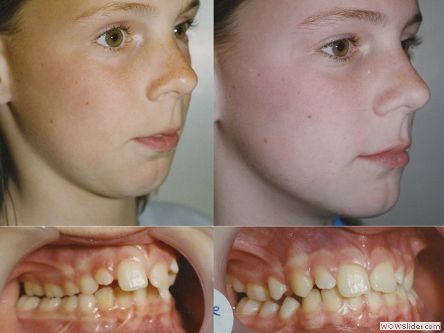 Facial Orthotropics Before and After