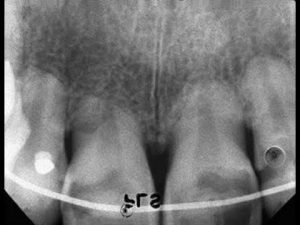 Tooth Root Resorption