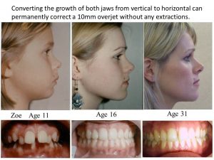 Before and After Orthodontic Treatment Timeline