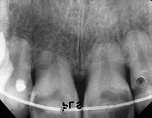 Tooth Root Resorption X-Ray