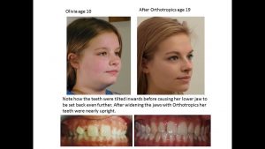 Long Term Consequences of Orthodontic Treatment, Orthotropics