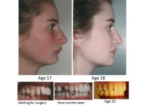 Before and After Orthodontic Treatment