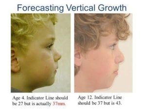 Forecasting Vertical Jaw Growth Orthodontic Treatment