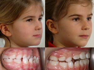 Orthodontic Treatment Before and After