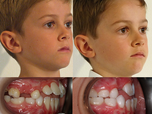 Orthodontic Treatment Before and After